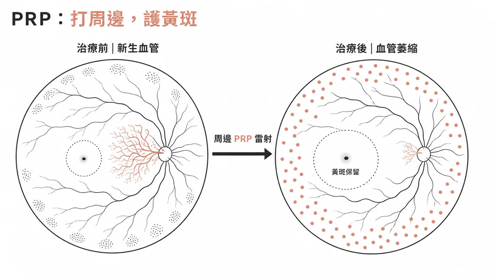 PRP 雷射破壞周邊缺氧視網膜以抑制新生血管