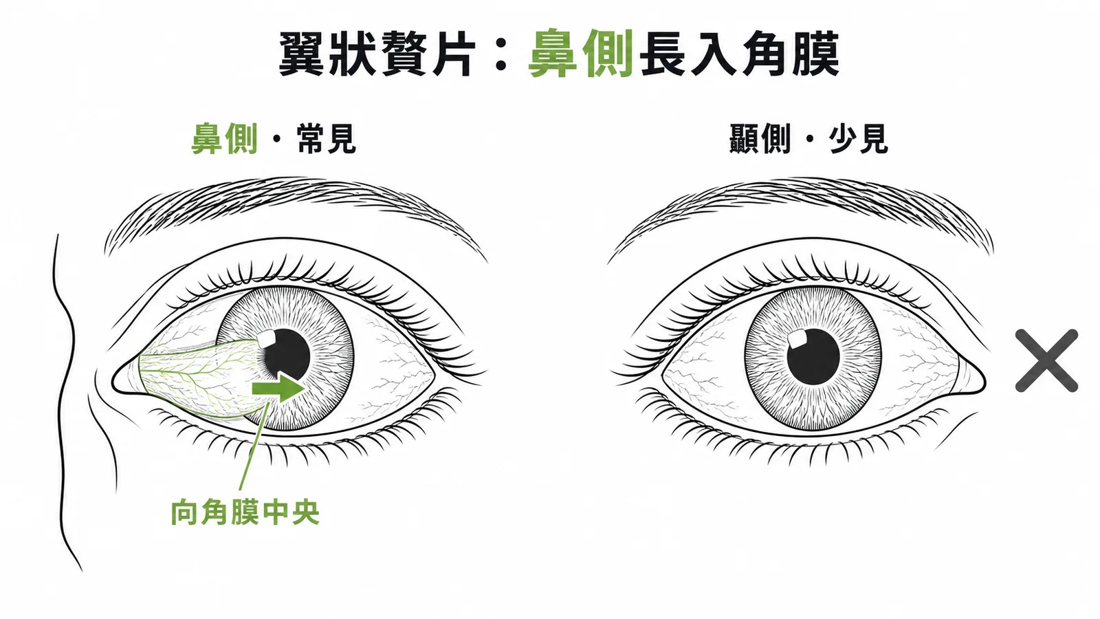 翼狀贅片好發於鼻側結膜並向角膜中央生長