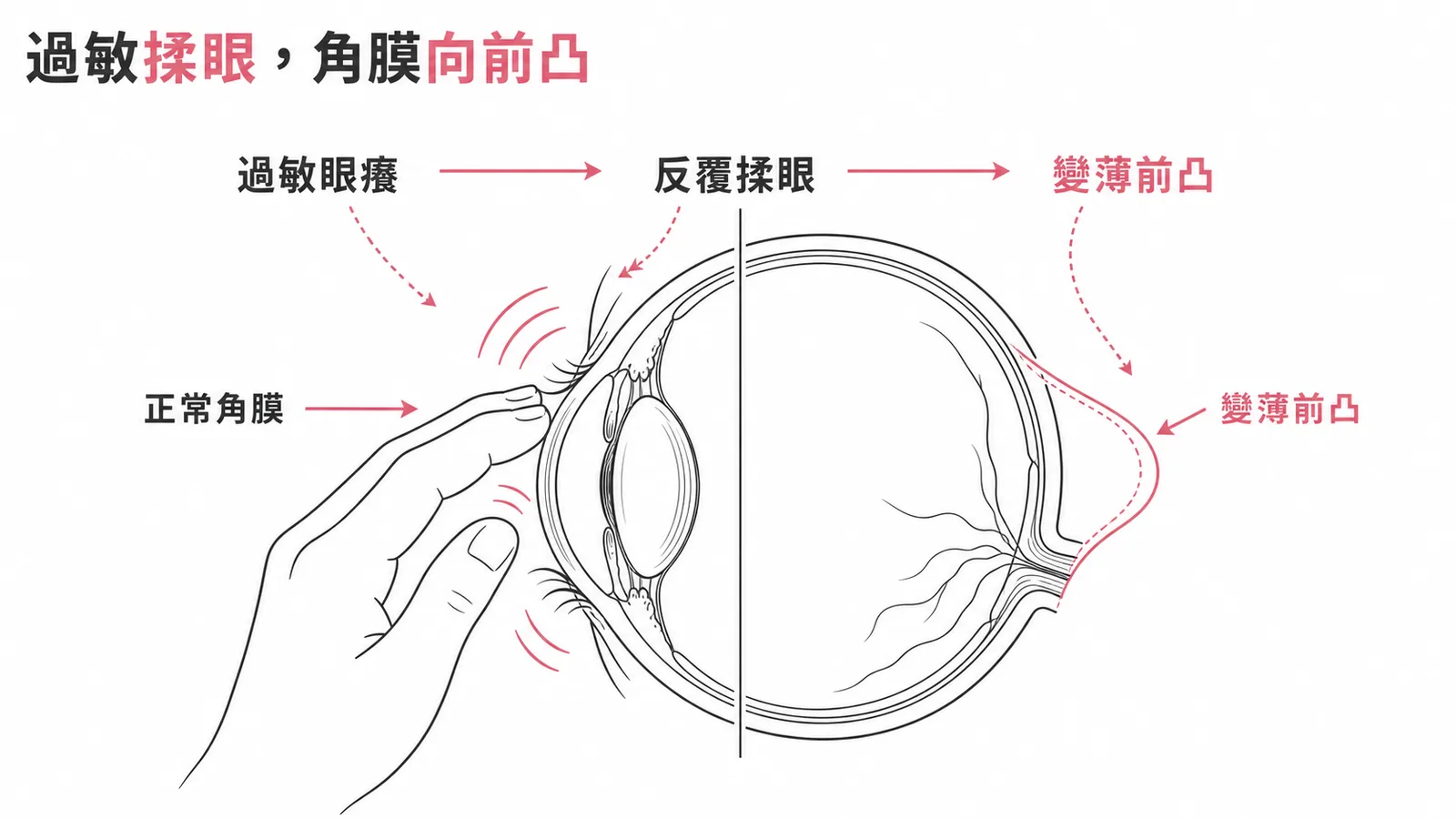 過敏揉眼導致角膜變薄前凸形成圓錐角膜