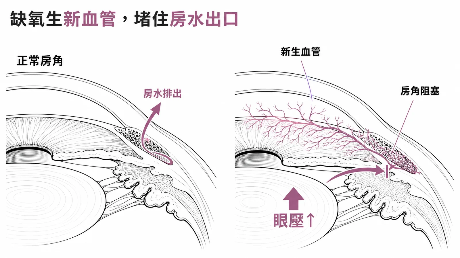 缺氧導致虹膜新生血管阻塞房角引發新生血管性青光眼