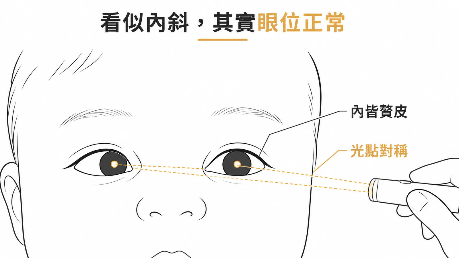 假性內斜視因內眥贅皮遮蓋眼白而看似內斜但光反射對稱證實眼位正常