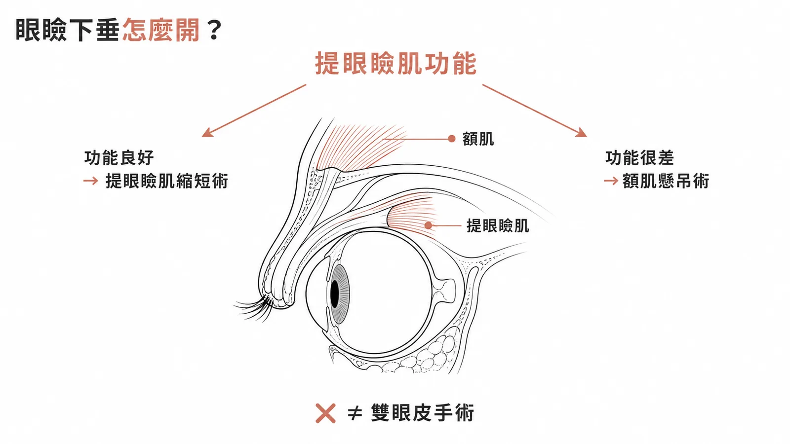 先天性眼瞼下垂手術選擇:依提眼瞼肌功能決定術式