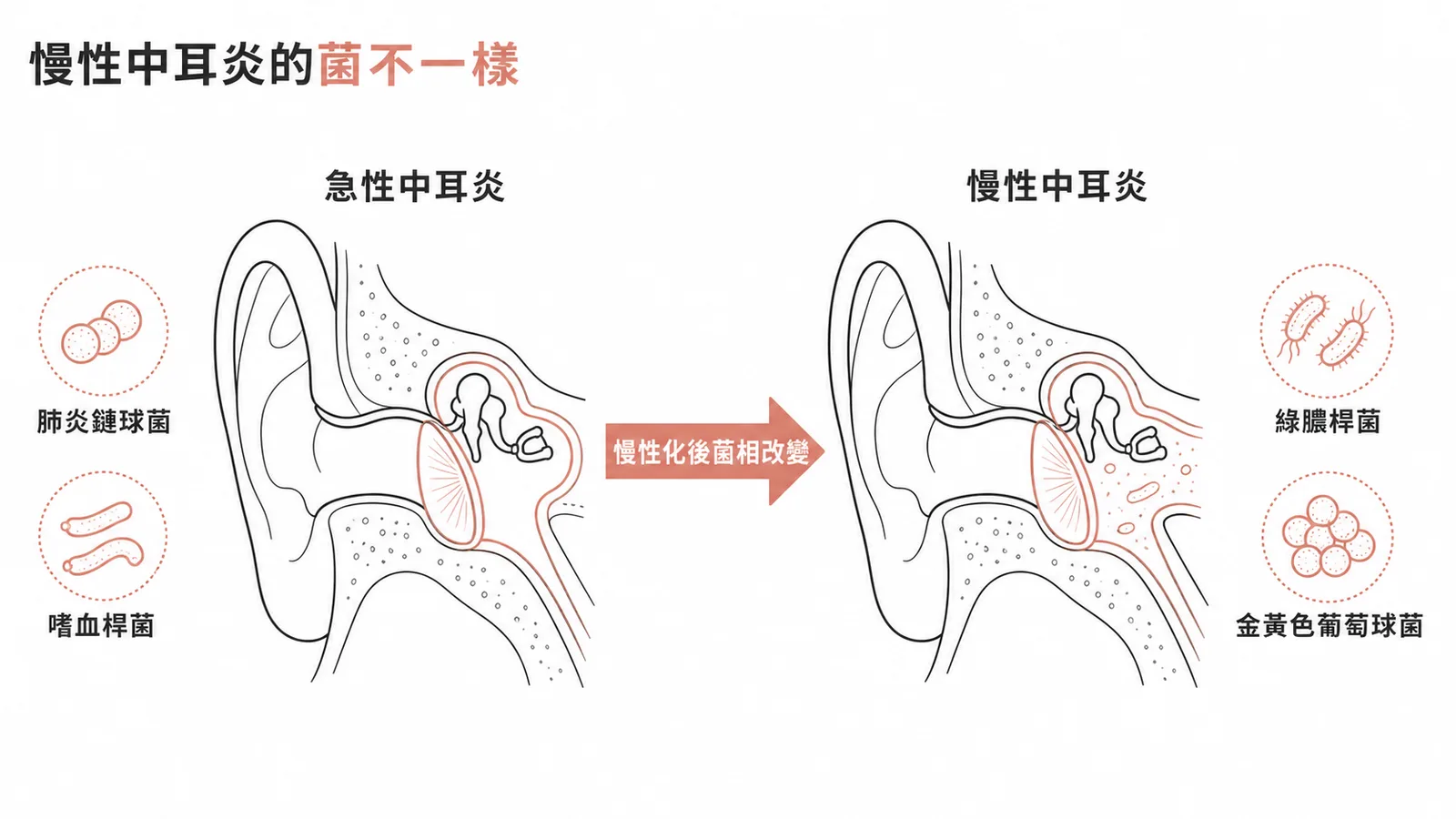 慢性中耳炎與急性中耳炎致病菌種對照