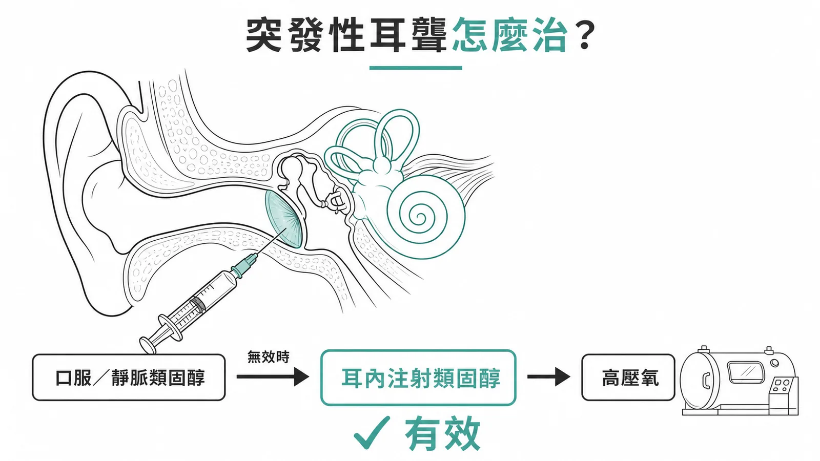 突發性耳聾治療流程：口服類固醇→耳內注射類固醇→高壓氧