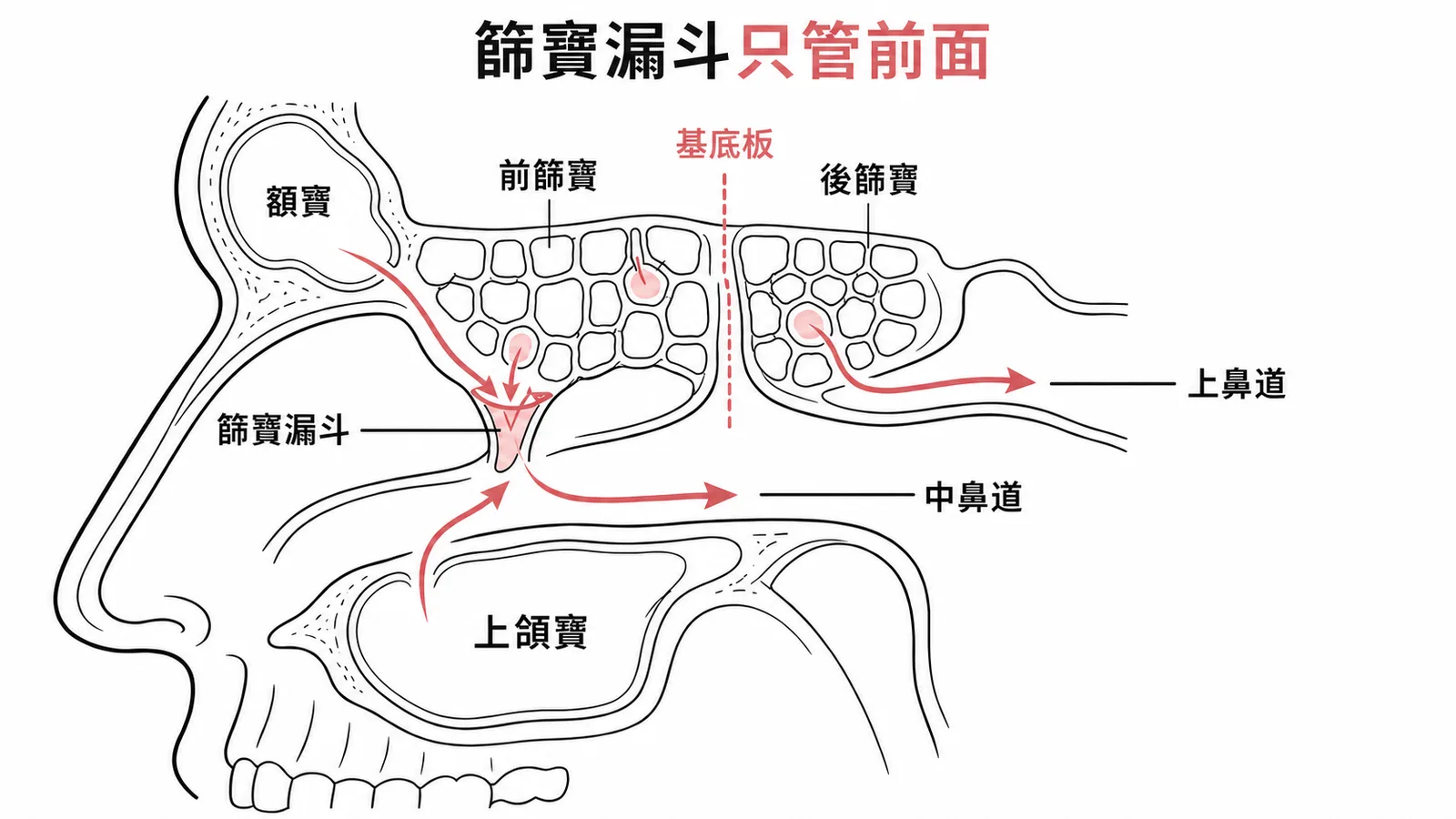 篩竇漏斗只引流前篩竇、上頜竇、額竇至中鼻道