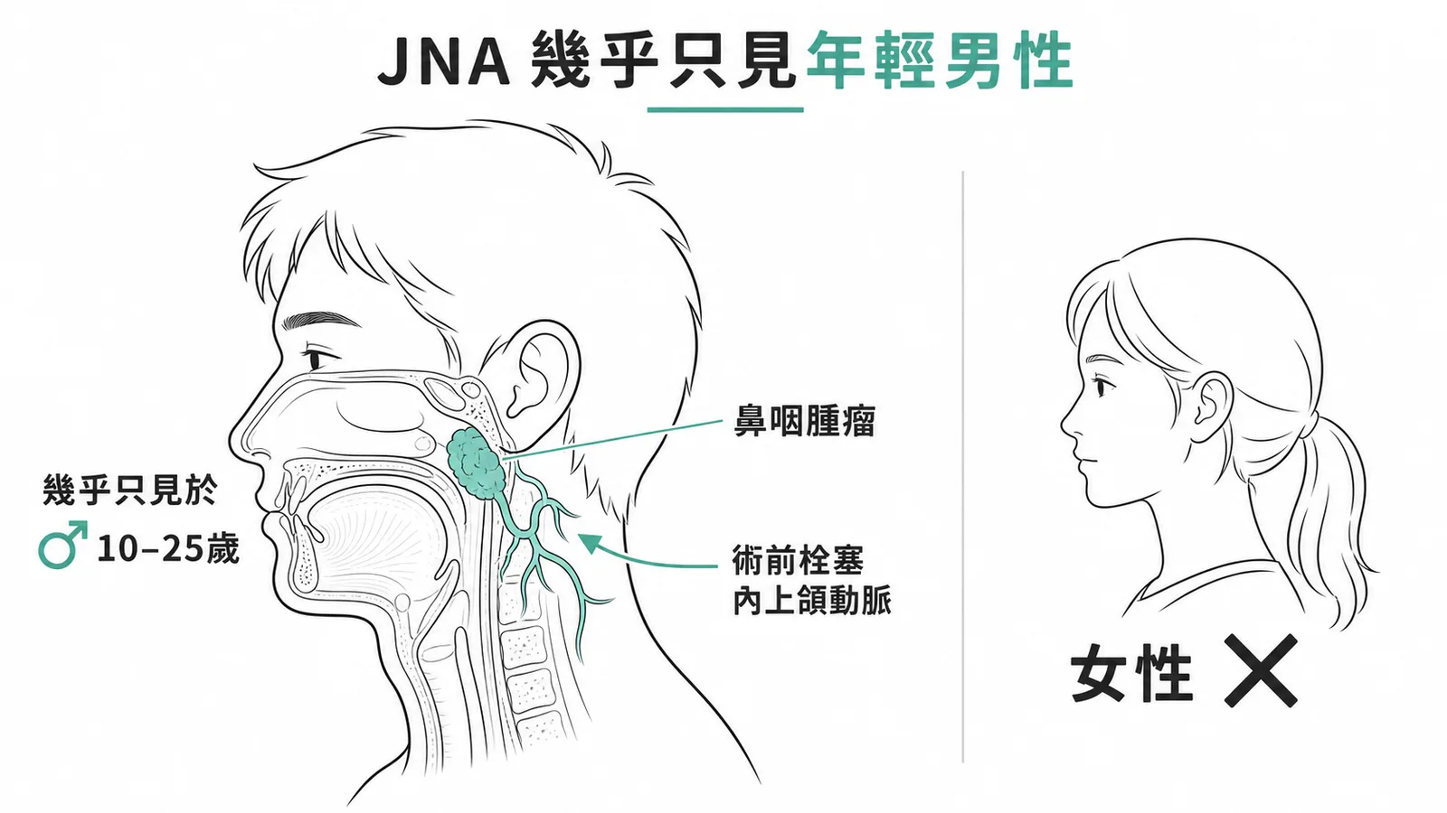 青少年鼻咽血管纖維瘤幾乎只見於年輕男性