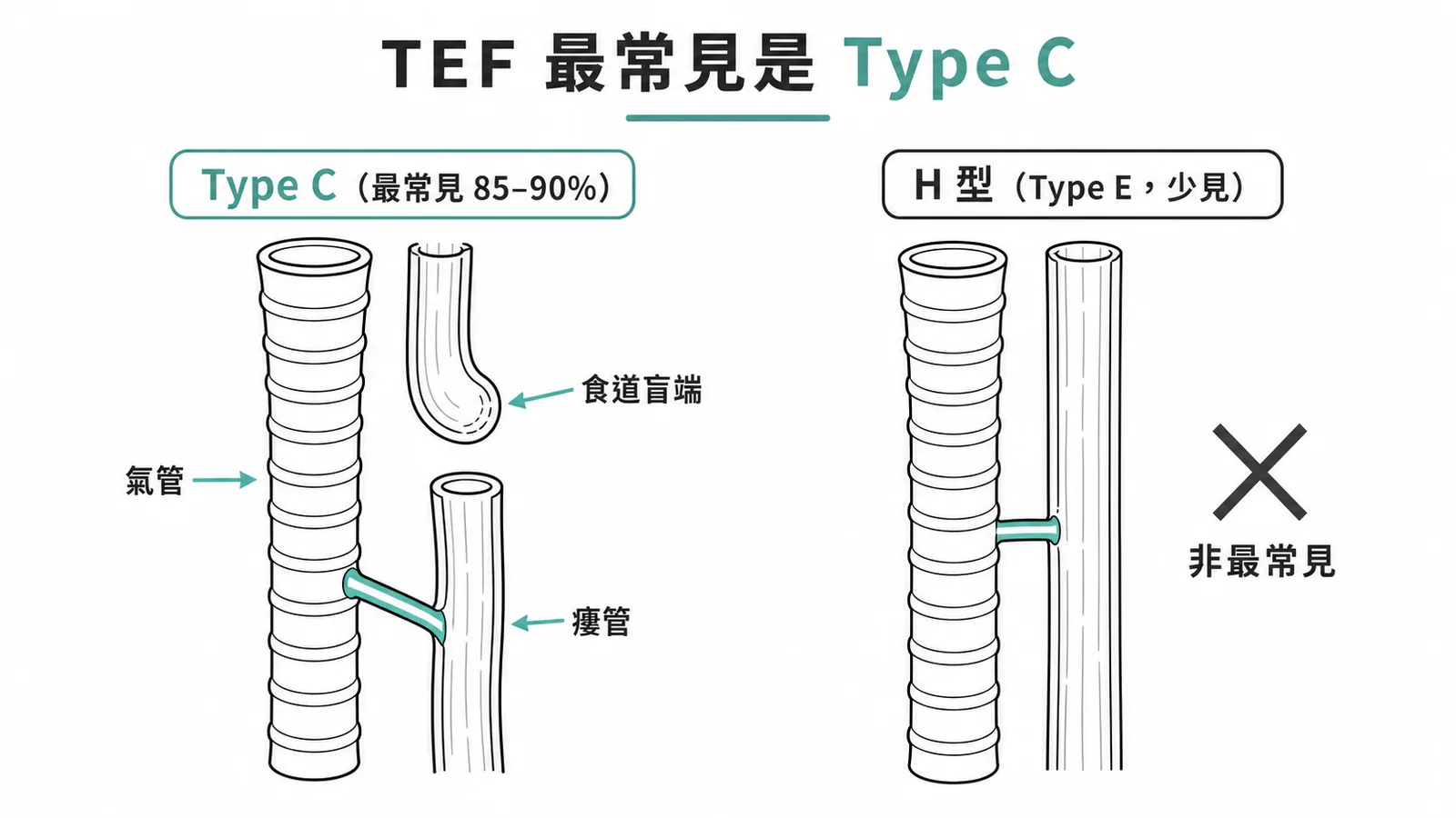 先天性氣管食道瘻管最常見 Type C：食道上段閉鎖、下段與氣管相通