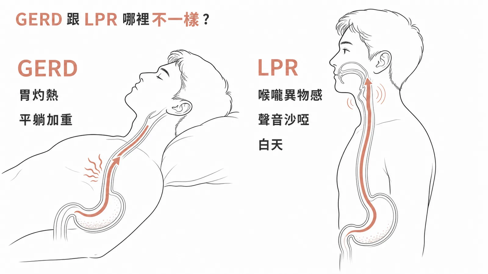 GERD 平躺加重胃灼熱 vs LPR 白天喉嚨異物感聲音沙啞
