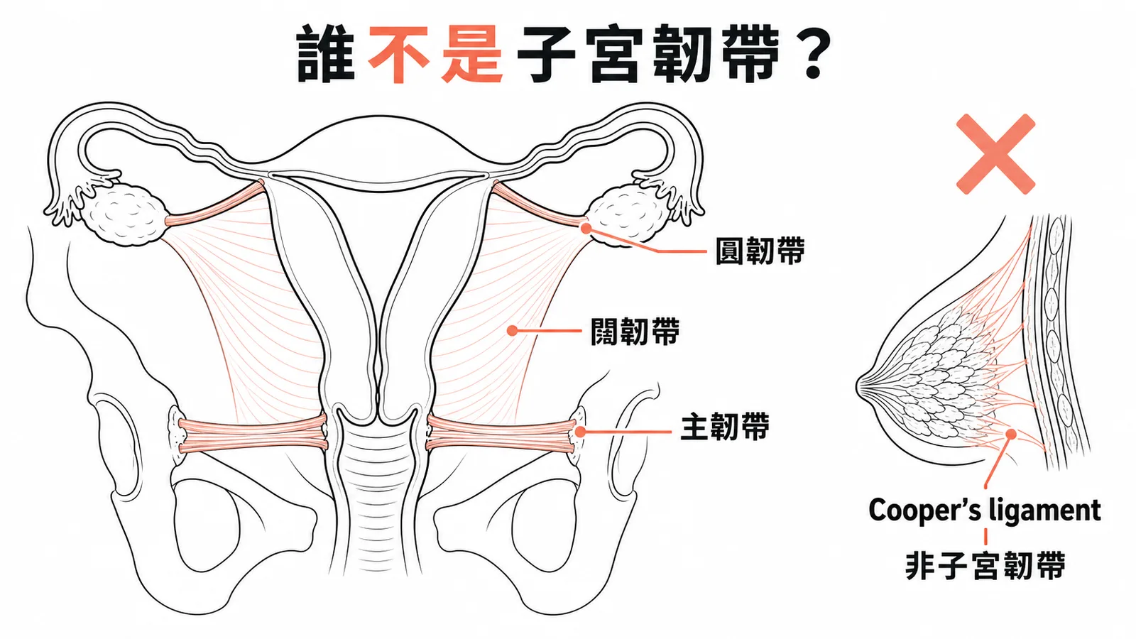 子宮韌帶辨識:闊韌帶、圓韌帶、主韌帶為子宮韌帶,Cooper's ligament 為乳房懸韌帶