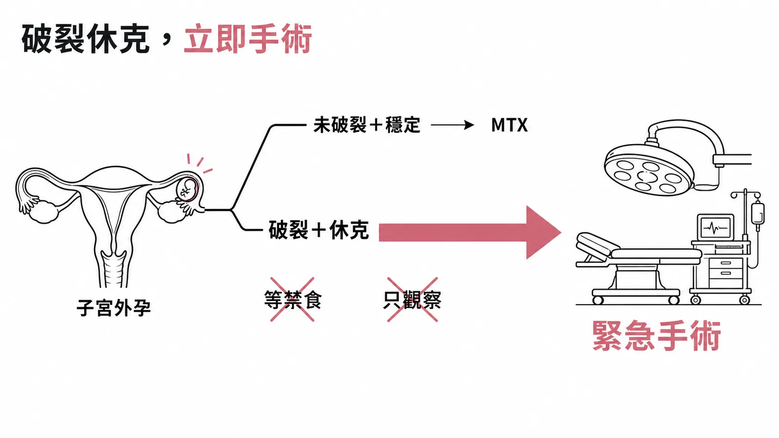 子宮外孕破裂合併休克必須立即手術，未破裂穩定才可用 MTX