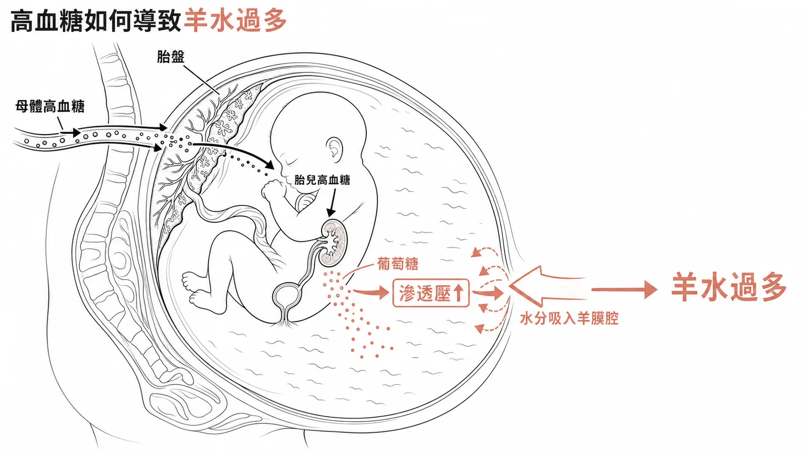妊娠糖尿病致羊水過多機轉：母體高血糖經胎盤使胎兒高血糖，葡萄糖排入羊水升高滲透壓