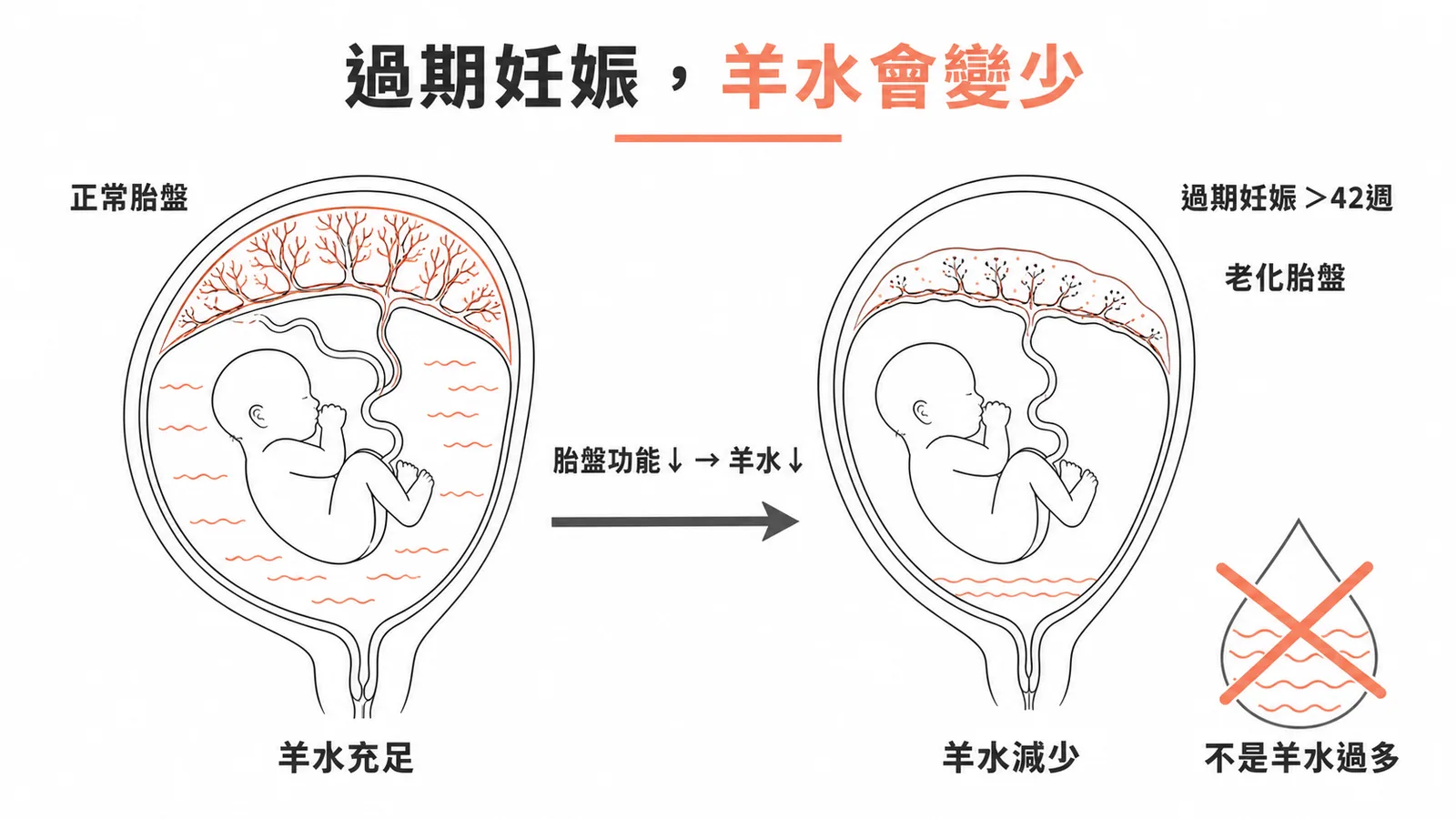 過期妊娠胎盤老化導致羊水減少而非羊水過多