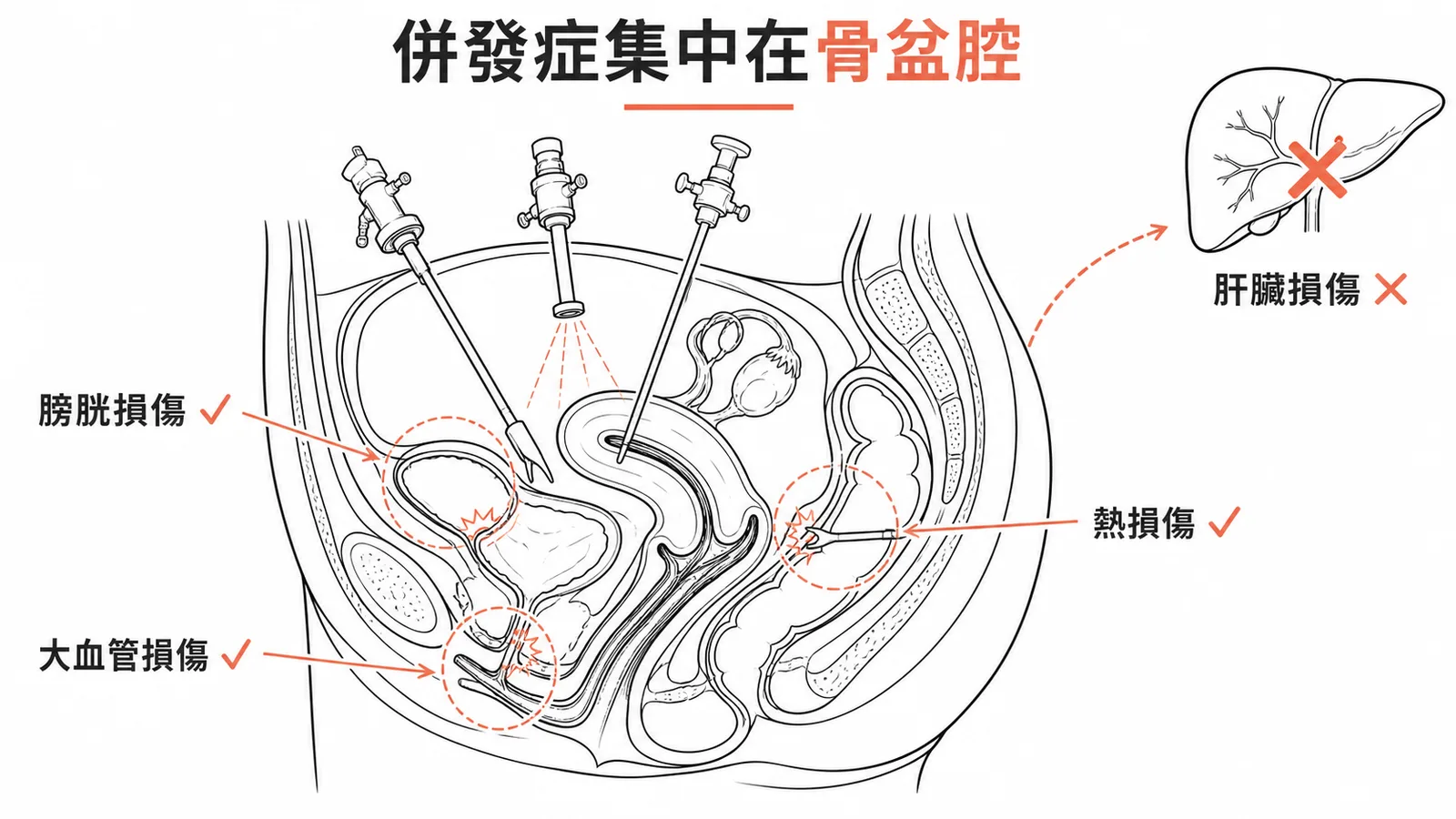 婦科腹腔鏡併發症集中在骨盆腔,肝臟損傷不常見