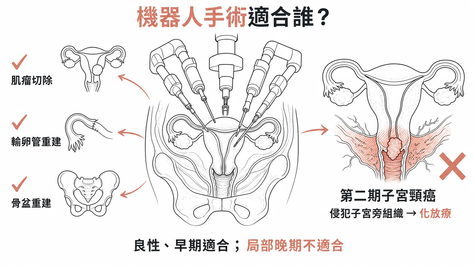 機器人手術適合良性與早期癌症，第二期子宮頸癌最不適當