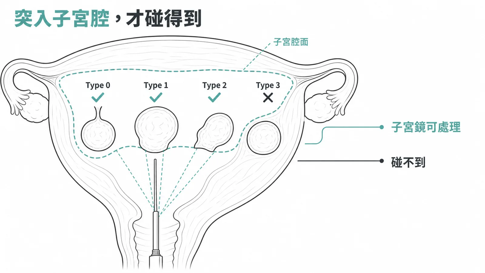 FIGO 子宮肌瘤分型：Type 0–2 突入子宮腔可用子宮鏡，Type 3 完全在肌層碰不到