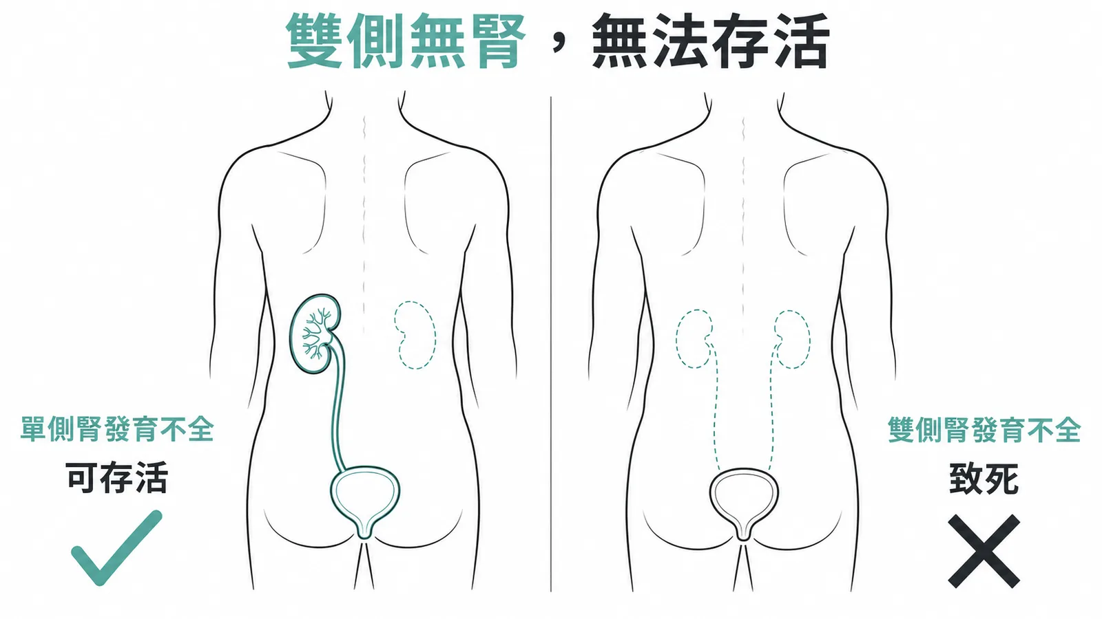 單側腎發育不全可存活，雙側腎發育不全（Potter syndrome）致死