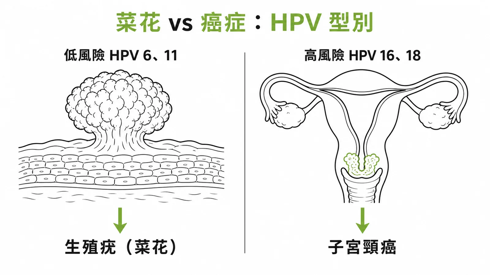 HPV 型別對照:低風險 6/11 引起菜花,高風險 16/18 引起子宮頸癌