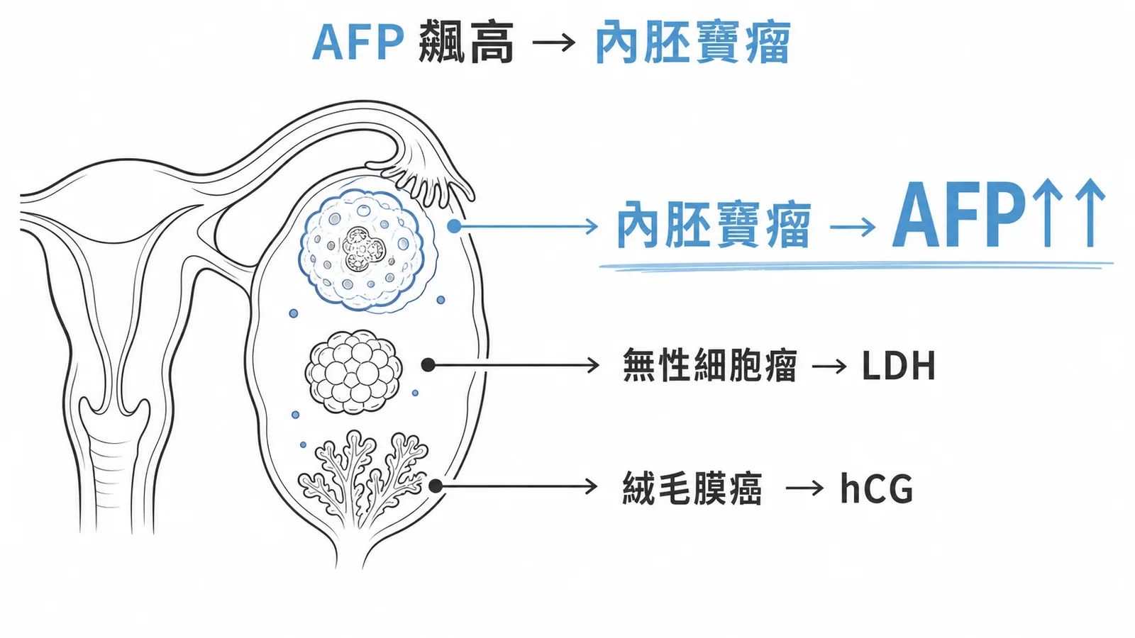 卵巢生殖細胞瘤腫瘤標記：AFP 飆高指向內胚竇瘤