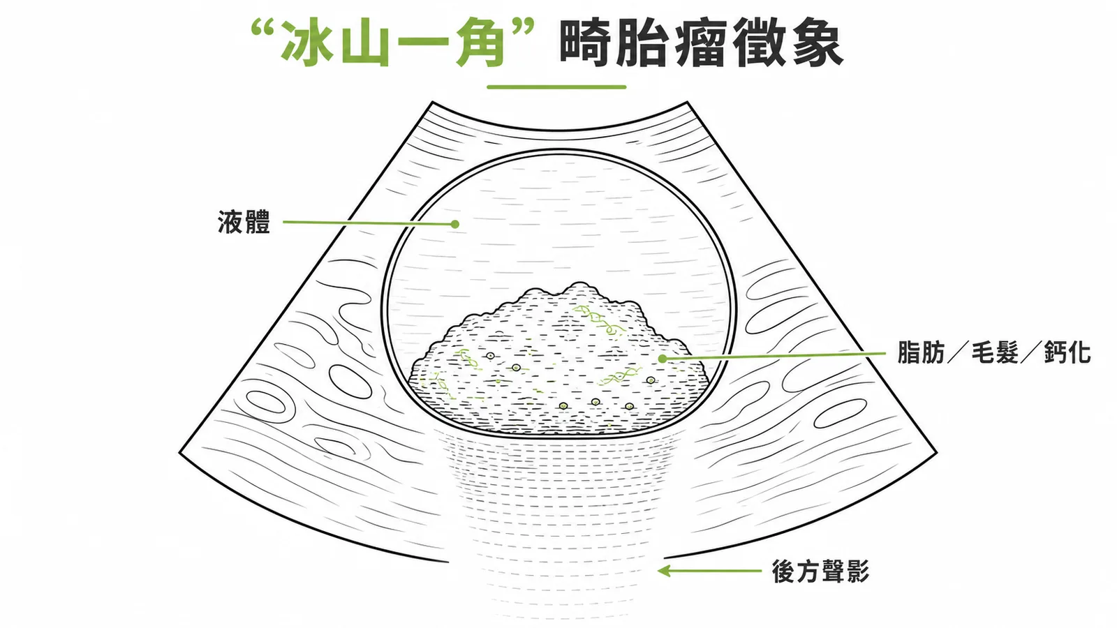 成熟囊性畸胎瘤超音波「冰山一角」徵象示意圖