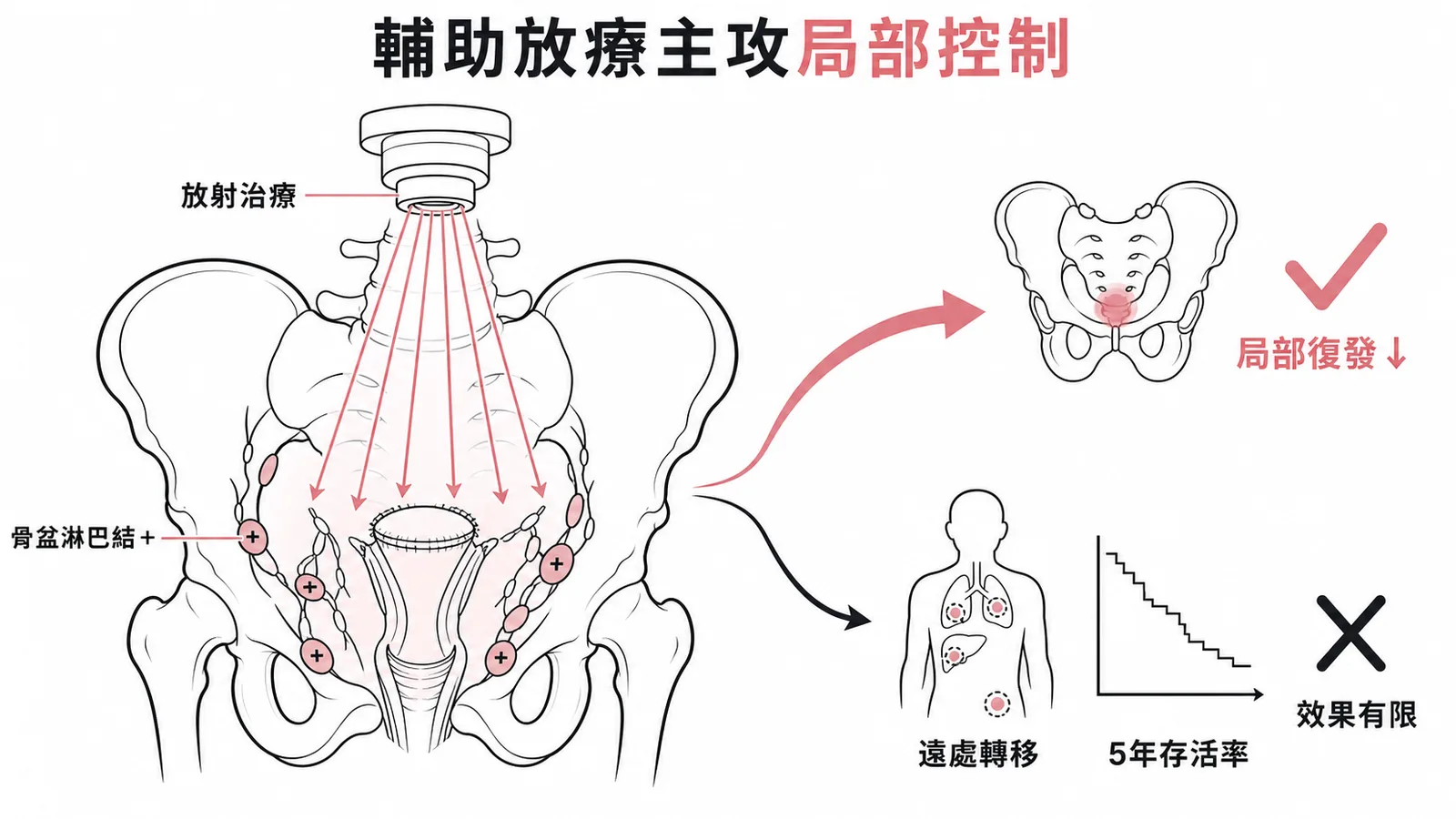 子宮頸癌術後輔助放療主攻局部控制,對遠處轉移及存活率效果有限