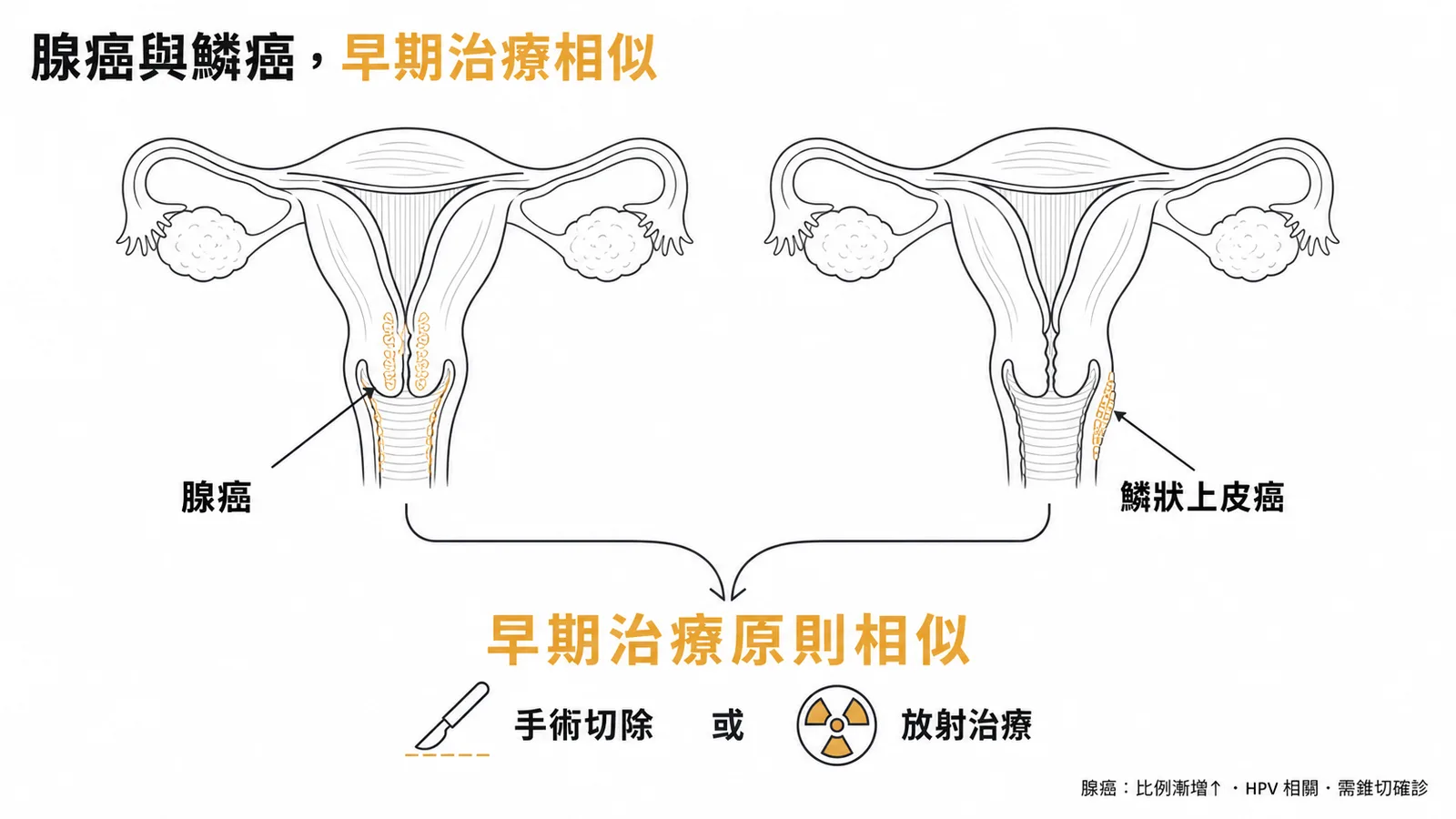 子宮頸腺癌與鱗狀上皮癌在早期治療原則相似