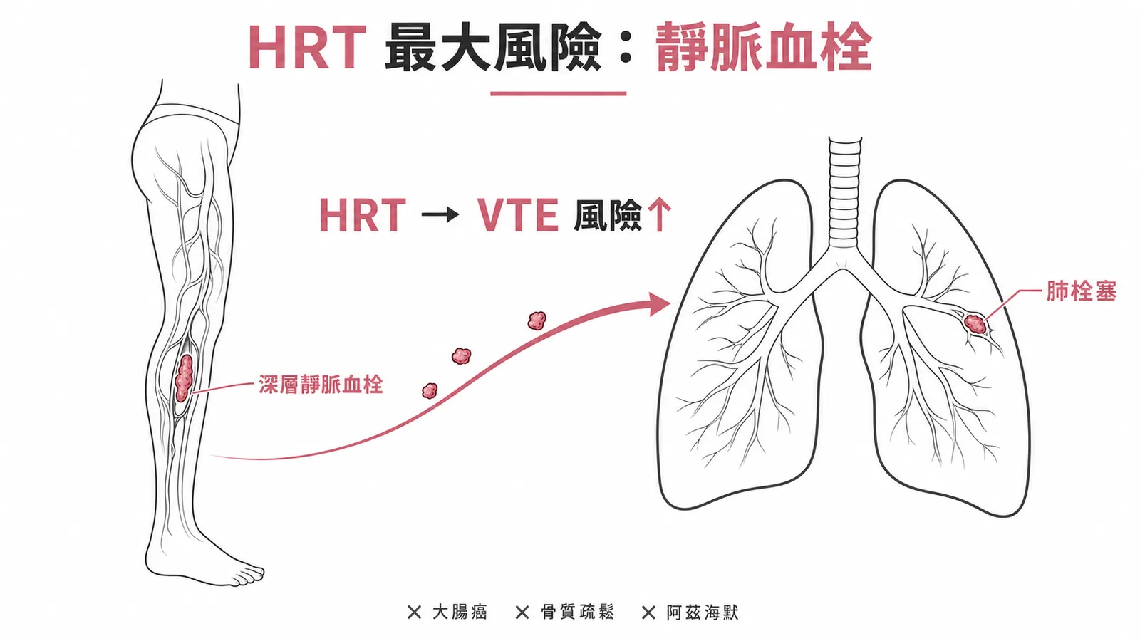 荷爾蒙療法增加靜脈血栓栓塞風險:DVT 可移行至肺栓塞