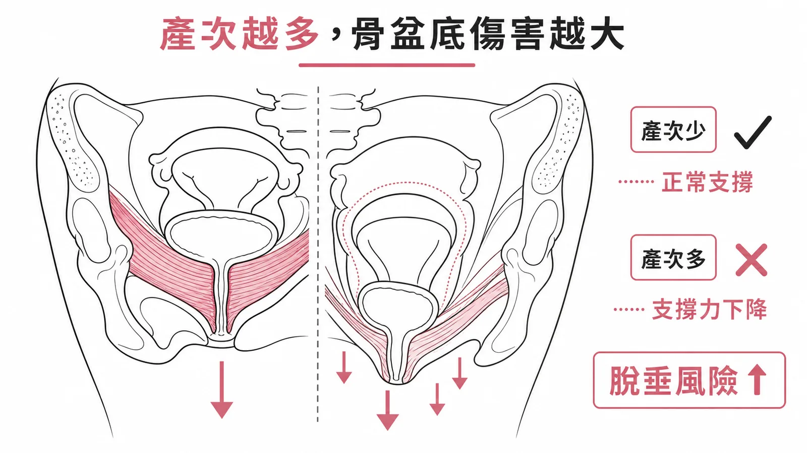 陰道生產累積傷害：產次越多骨盆底支撐力越弱，脫垂風險越高