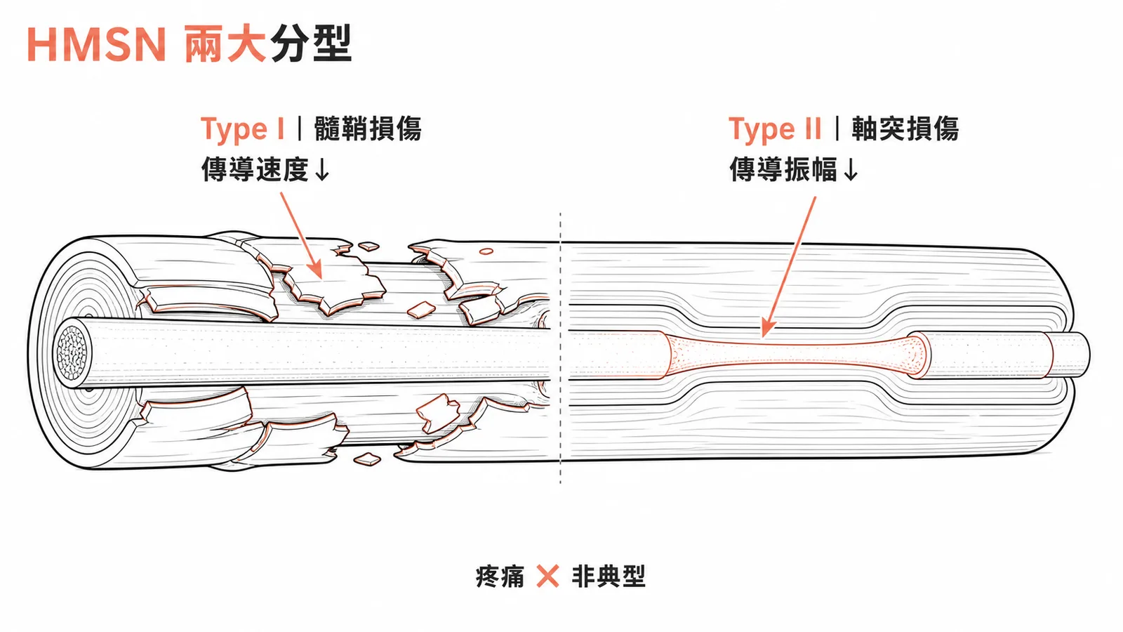 HMSN兩大分型:Type I髓鞘損傷致傳導速度下降,Type II軸突損傷致振幅降低,疼痛非典型表現
