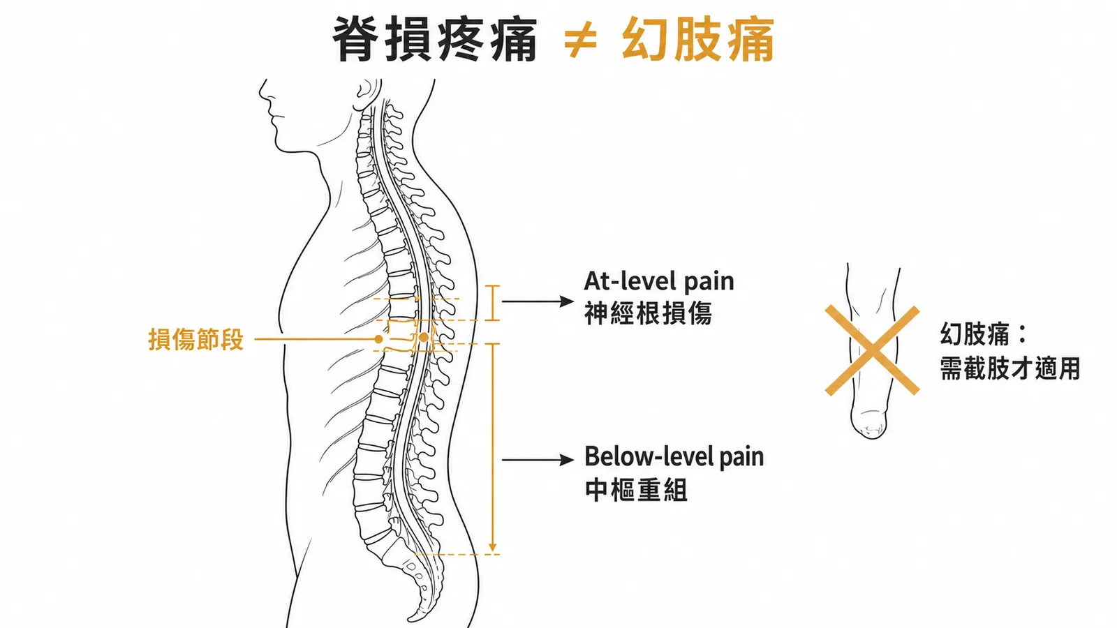 脊損疼痛分類:At-level為神經根損傷、Below-level為中樞重組,兩者皆非幻肢痛
