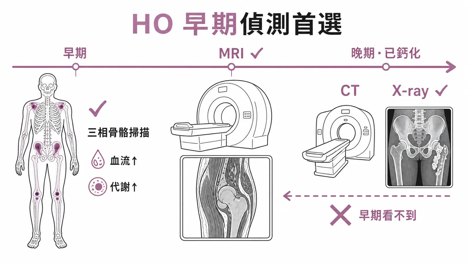 異位性骨化早期偵測首選:三相骨骼掃描能偵測血流與代謝變化,比X-ray和CT更早發現
