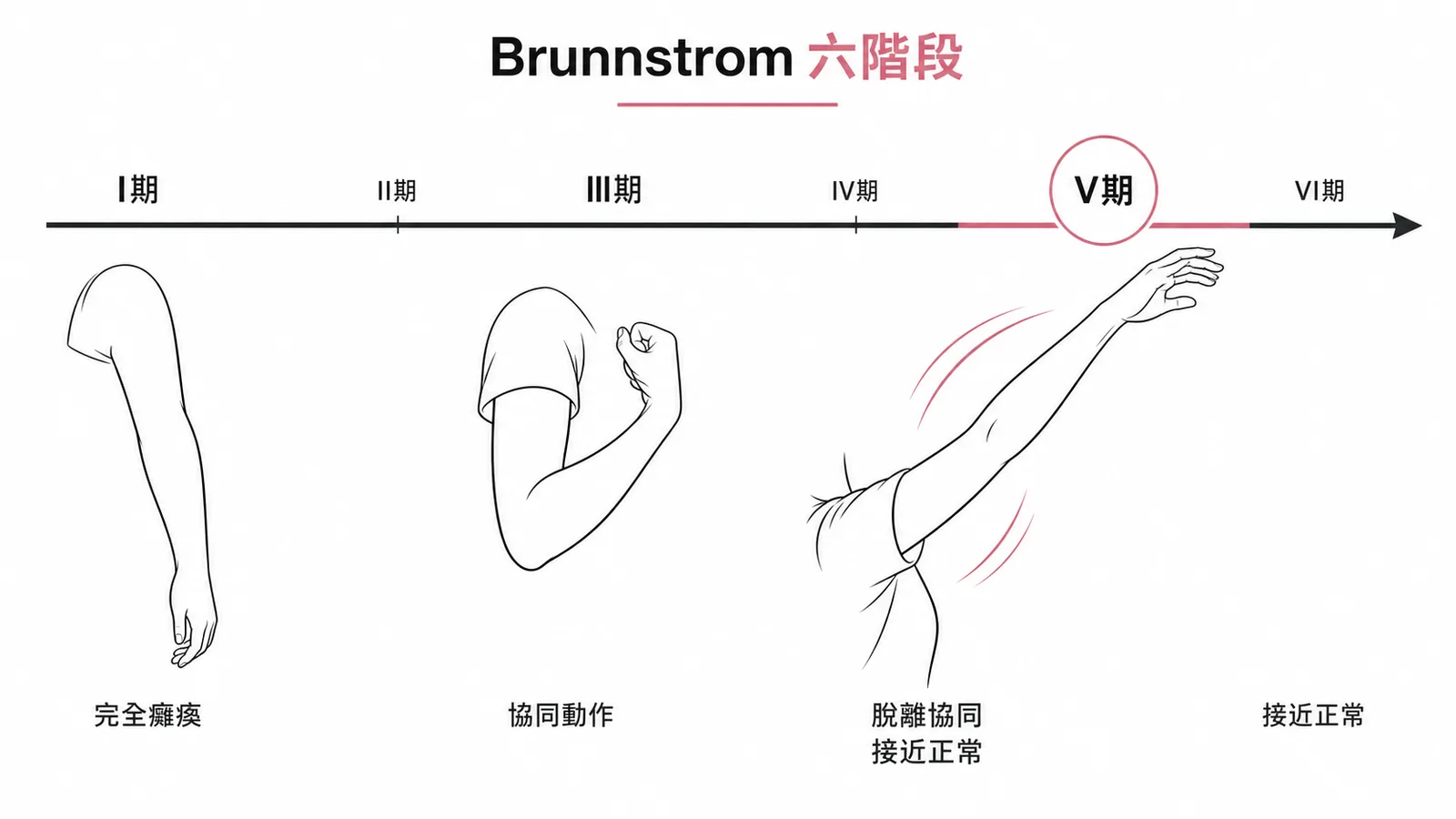 Brunnstrom六階段:Stage V大部分動作脫離協同模式、接近正常獨立動作