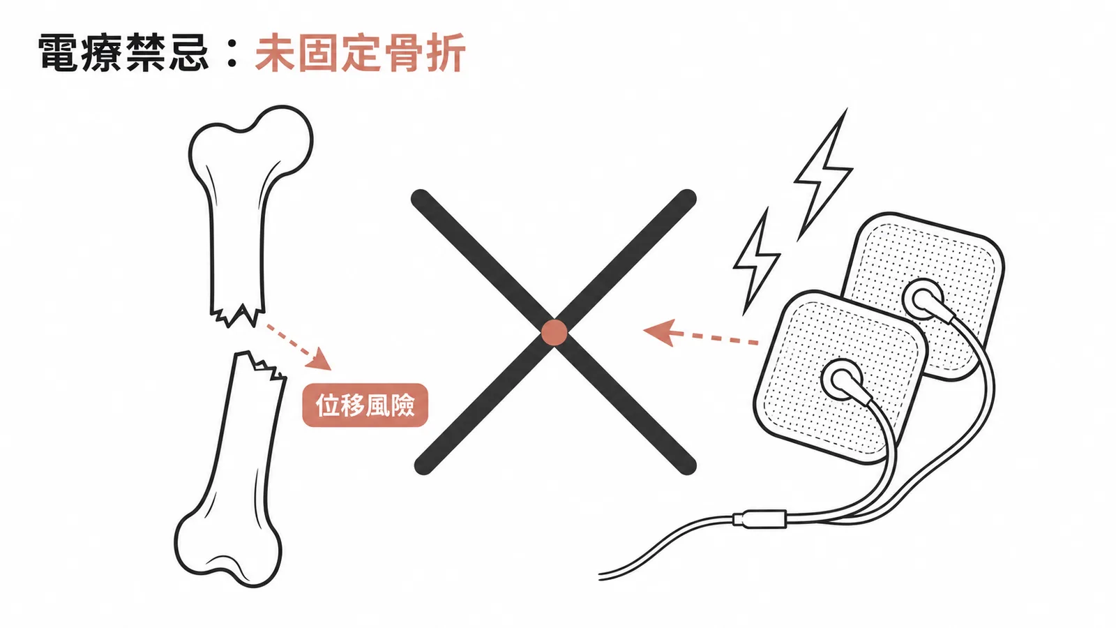 電療禁忌:未經固定的急性骨折部位不可施以電療,有骨折段位移風險