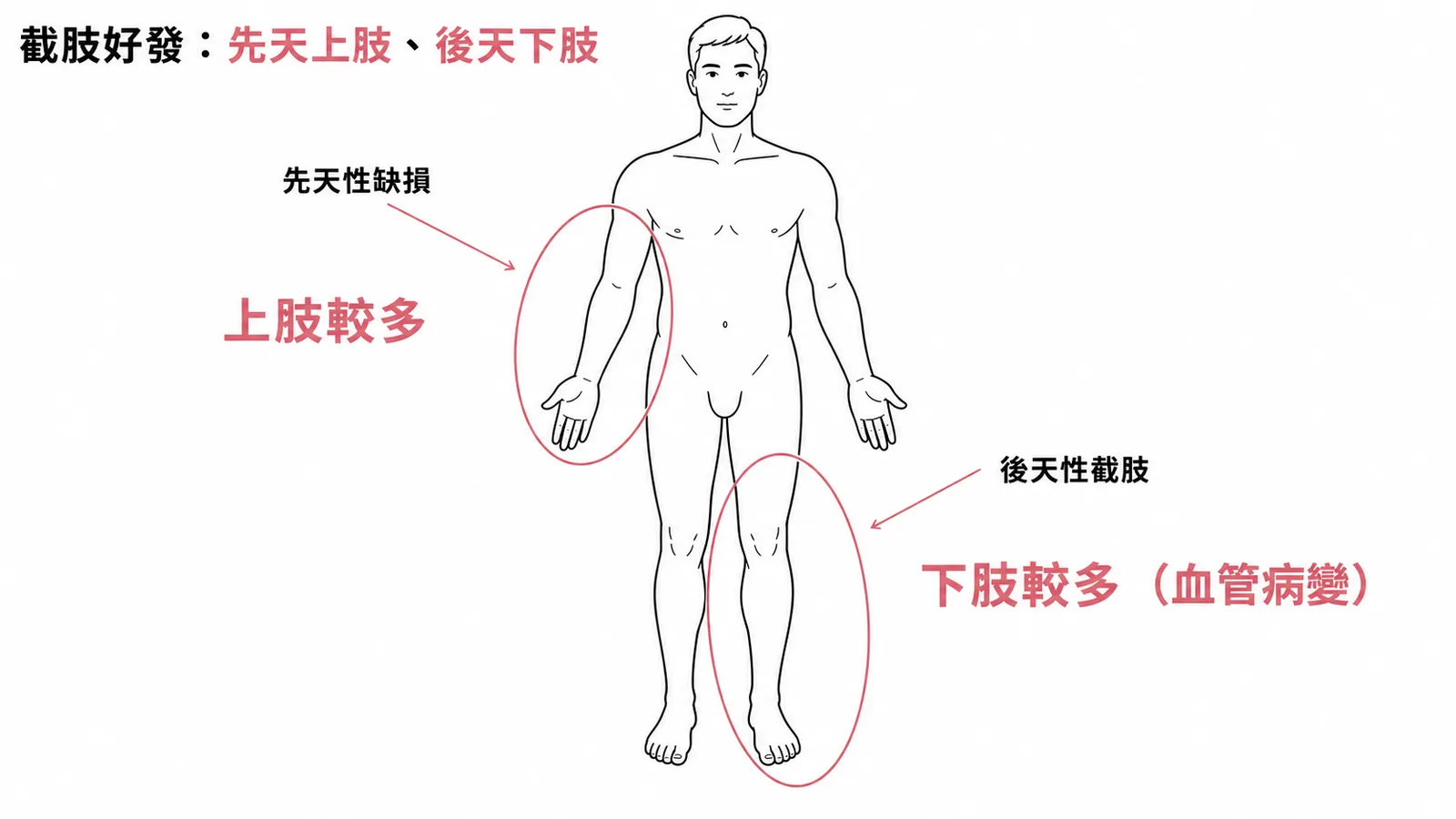 截肢好發部位:先天性缺損以上肢較多,後天性截肢以下肢較多(血管病變)