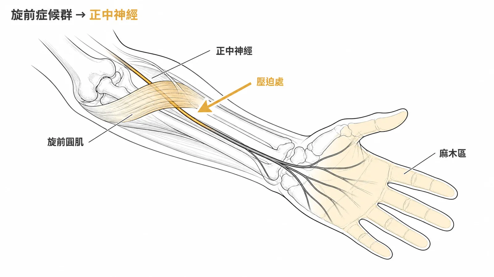 旋前症候群:正中神經在旋前圓肌處受壓迫,導致前臂疼痛與拇食中指麻木