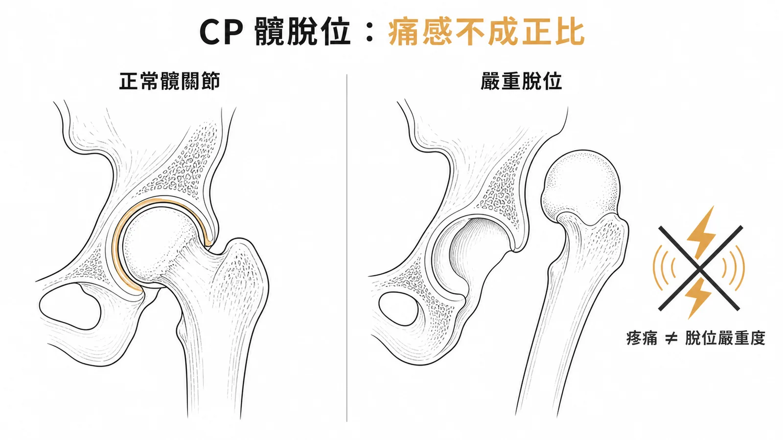 腦性麻痺髖關節脫位:疼痛程度與脫位嚴重度不成正比