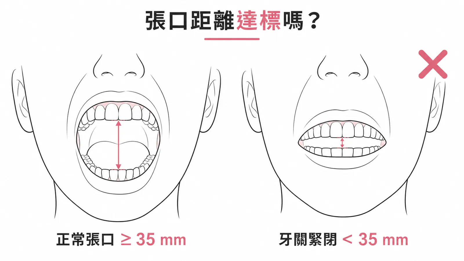 牙關緊閉診斷標準:正常張口≥35mm vs 牙關緊閉<35mm