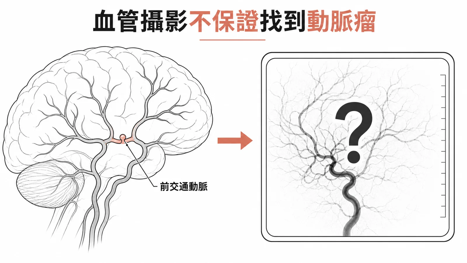 血管攝影不保證找到動脈瘤，SAH假陰性率約10-15%