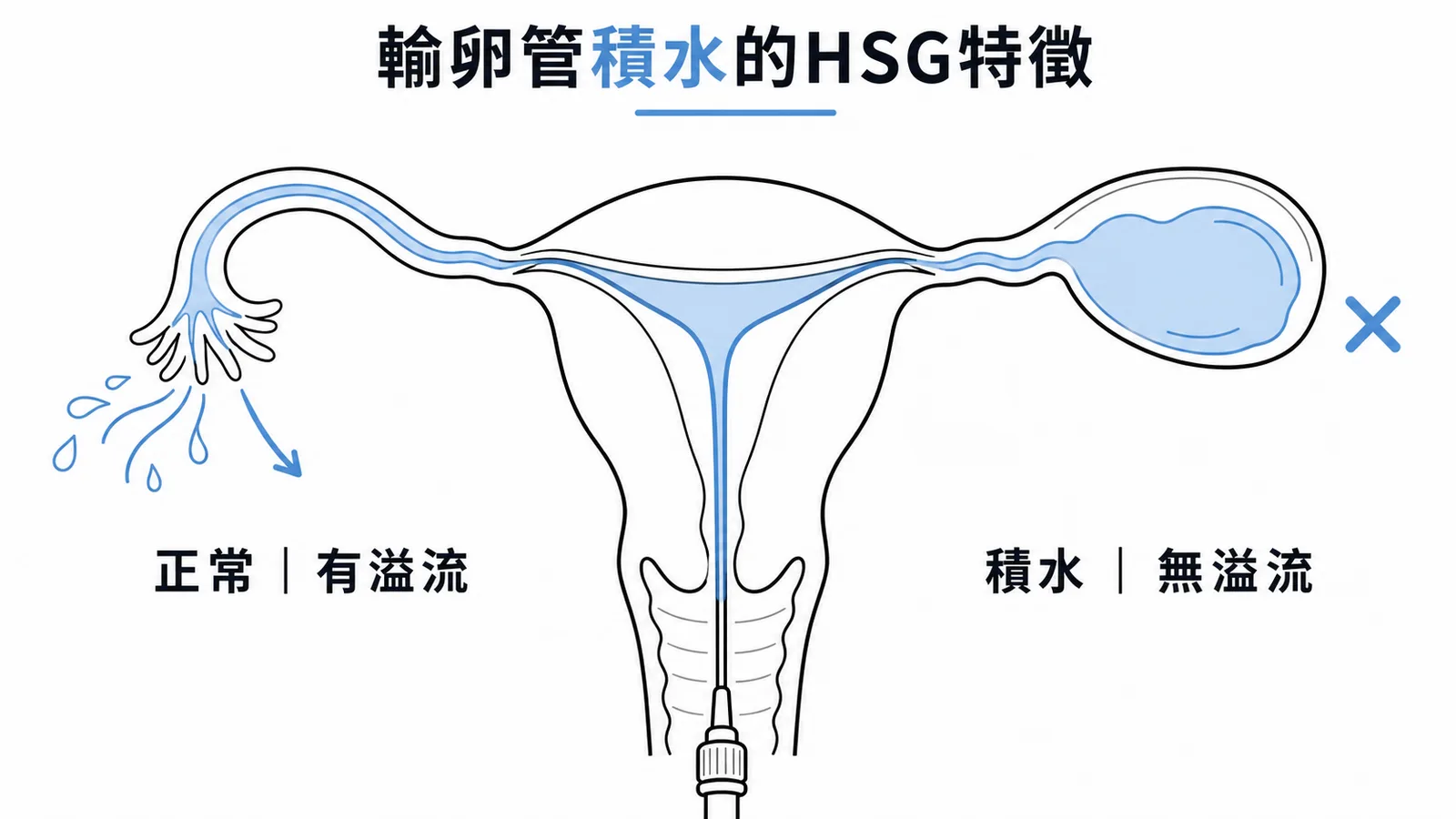 輸卵管積水的HSG特徵：末端囊狀擴張且無腹腔溢流