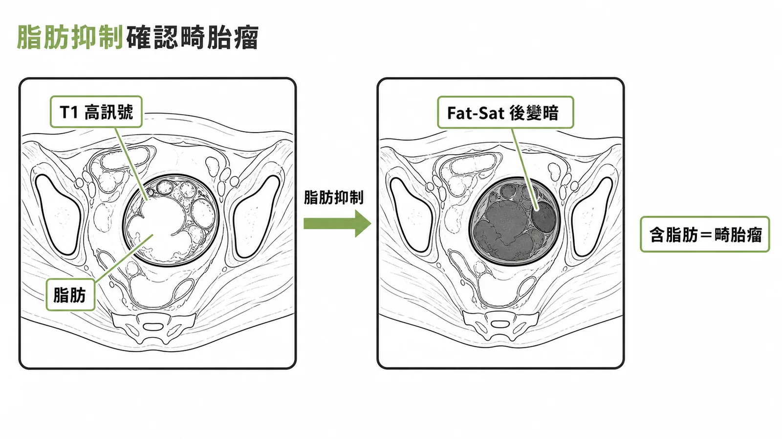 脂肪抑制確認畸胎瘤：T1高訊號在Fat-Sat後變暗