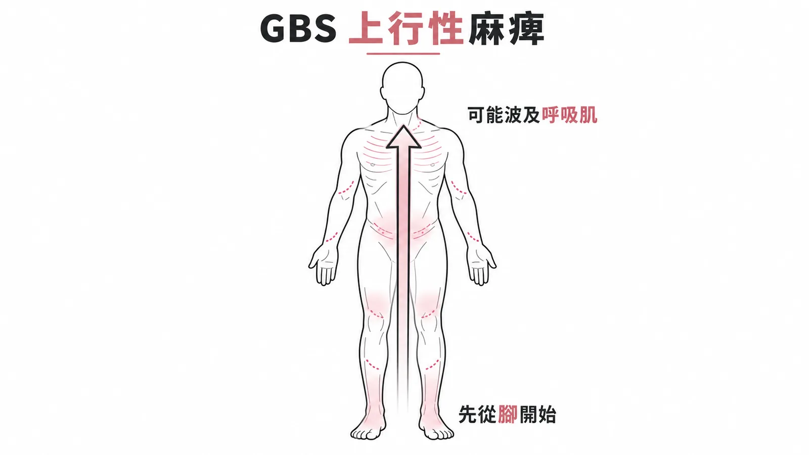 GBS上行性麻痺:從下肢往上蔓延,可能波及呼吸肌