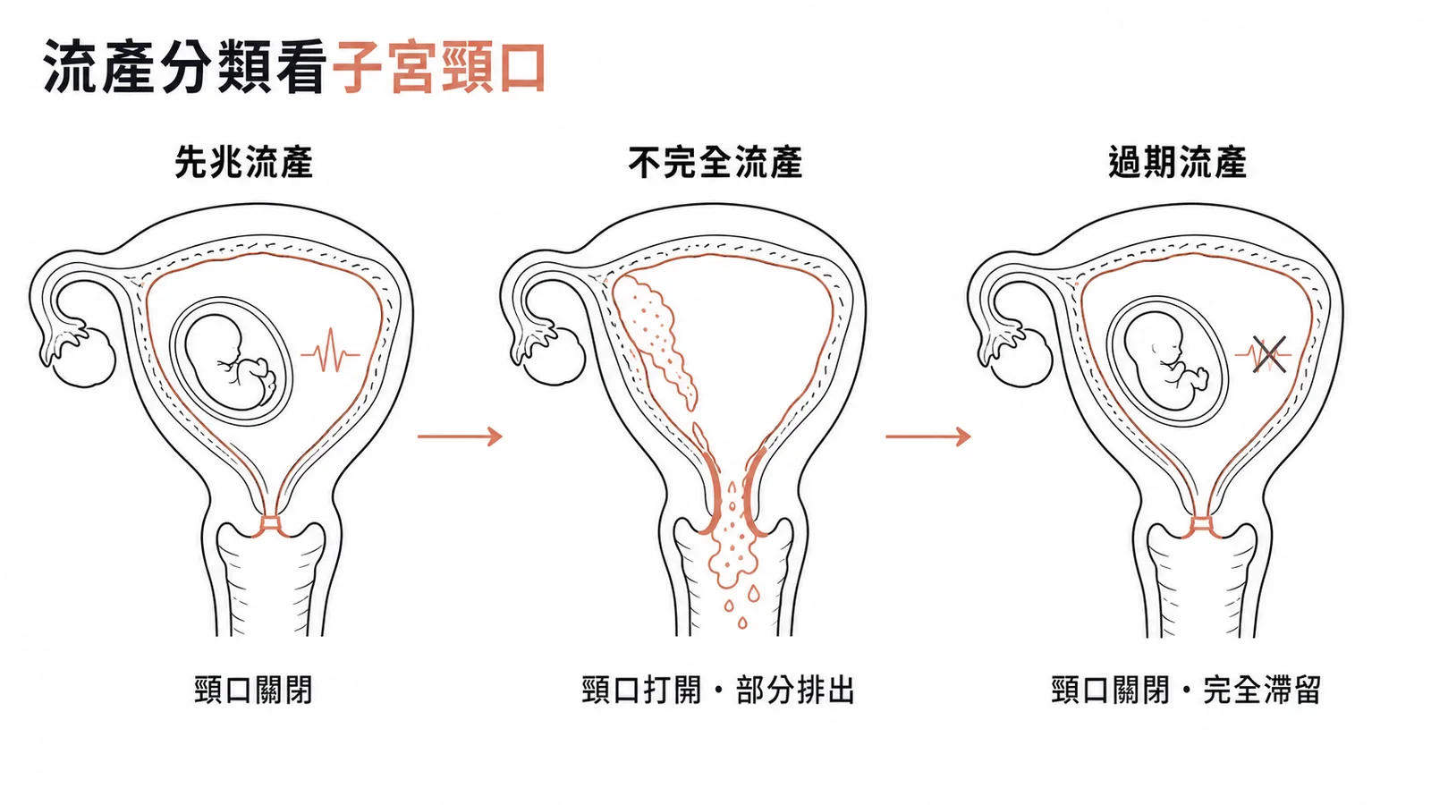 流產分類:依子宮頸口開閉與組織排出狀態區分