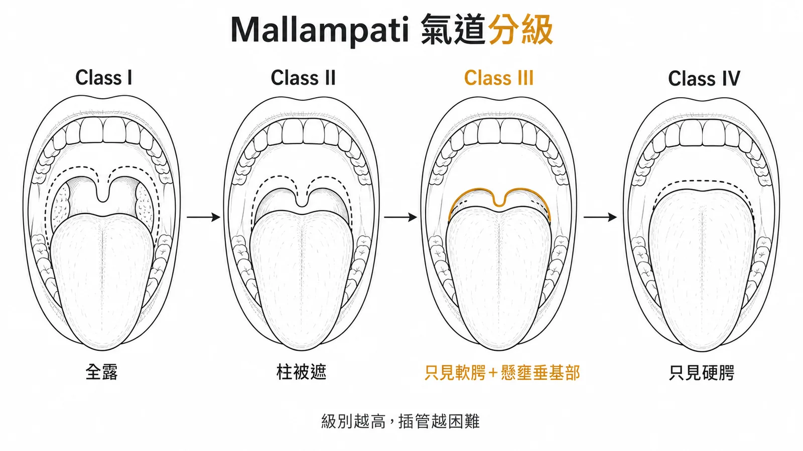 Mallampati四級氣道分級示意圖