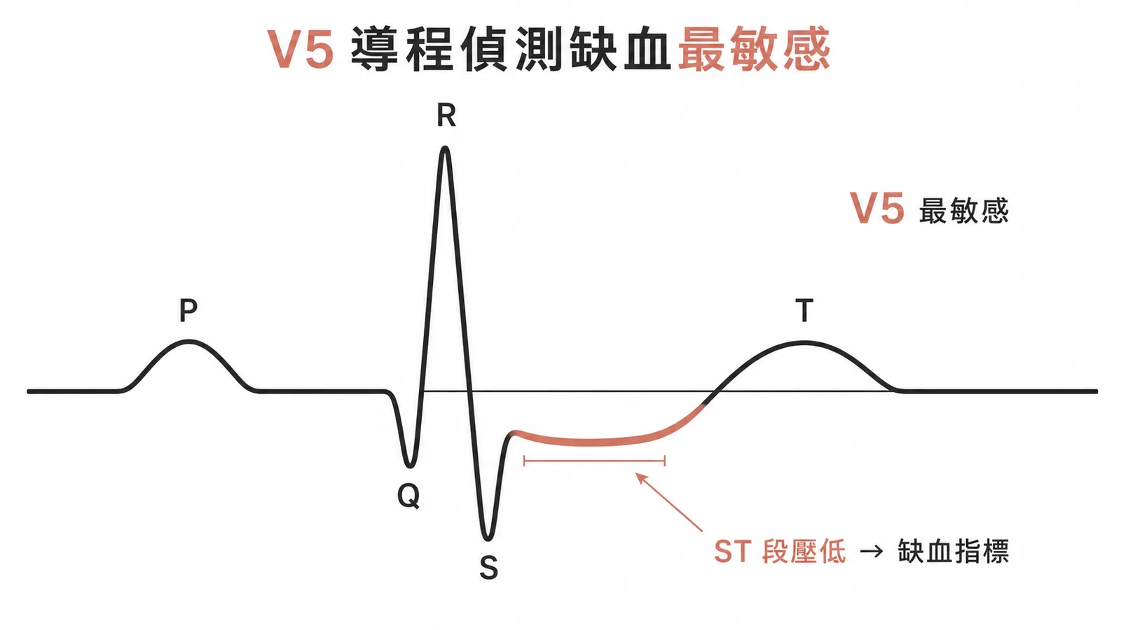 V5導程對術中心肌缺血偵測最敏感