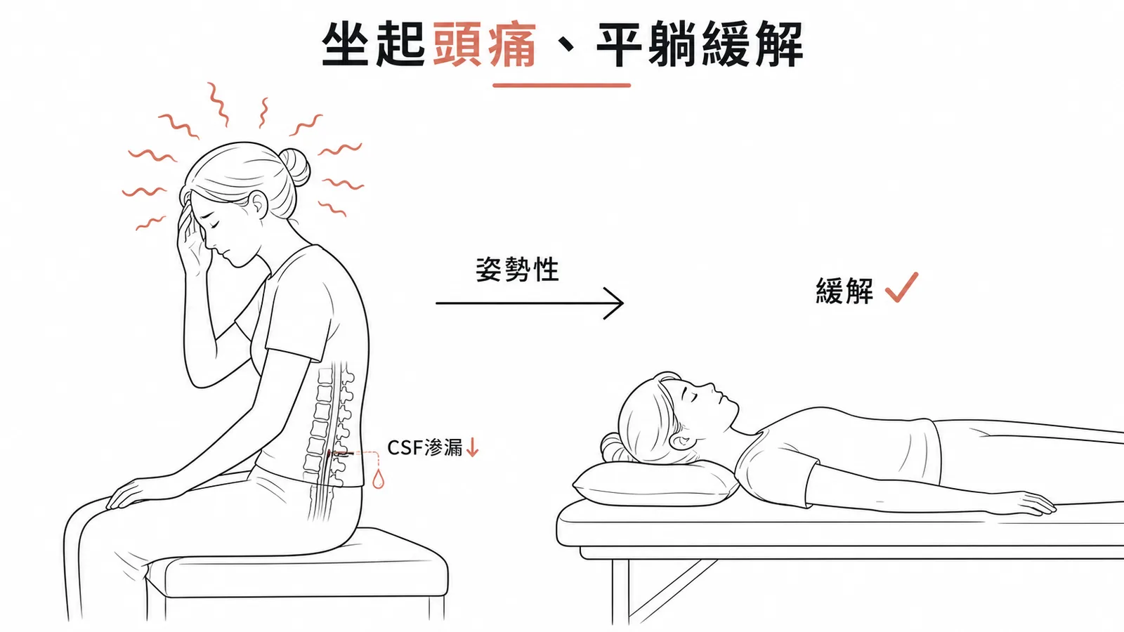 硬脊膜穿刺後頭痛的姿勢性特徵示意