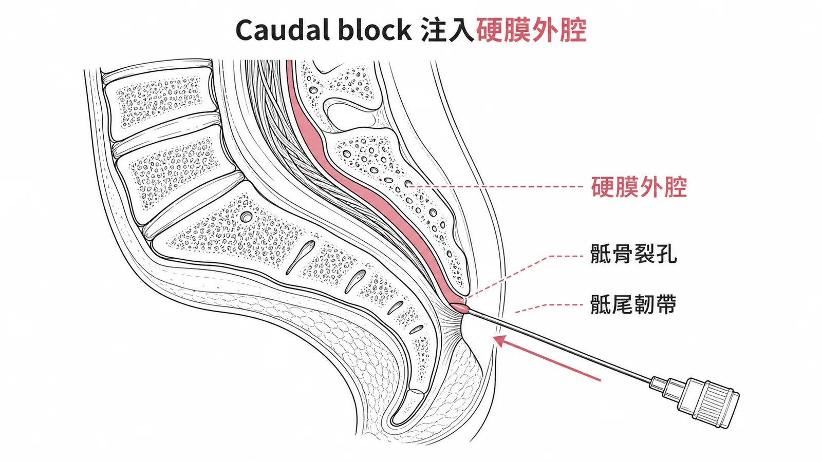 Caudal block 從骶骨裂孔注入硬膜外腔的解剖示意圖