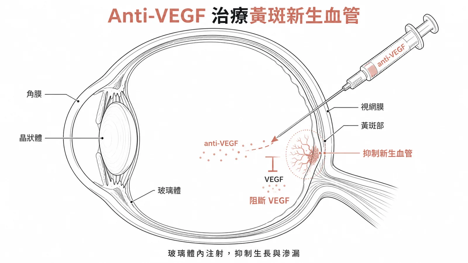 Anti-VEGF玻璃體內注射治療高度近視黃斑部新生血管示意圖