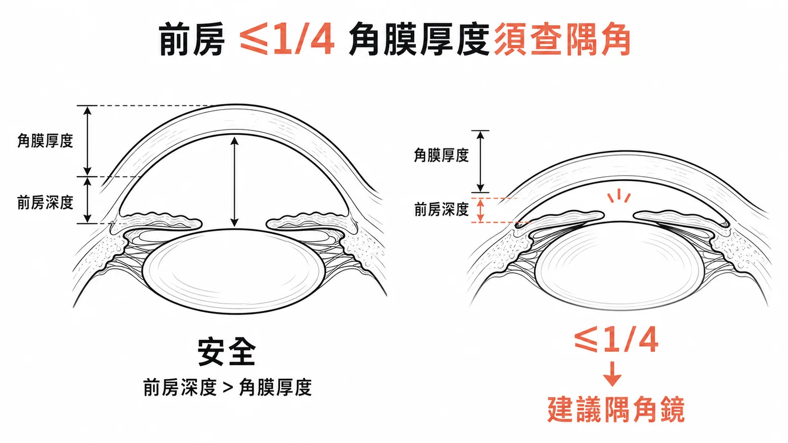 Van Herick法前房深度小於等於四分之一角膜厚度時建議隅角鏡檢查示意圖