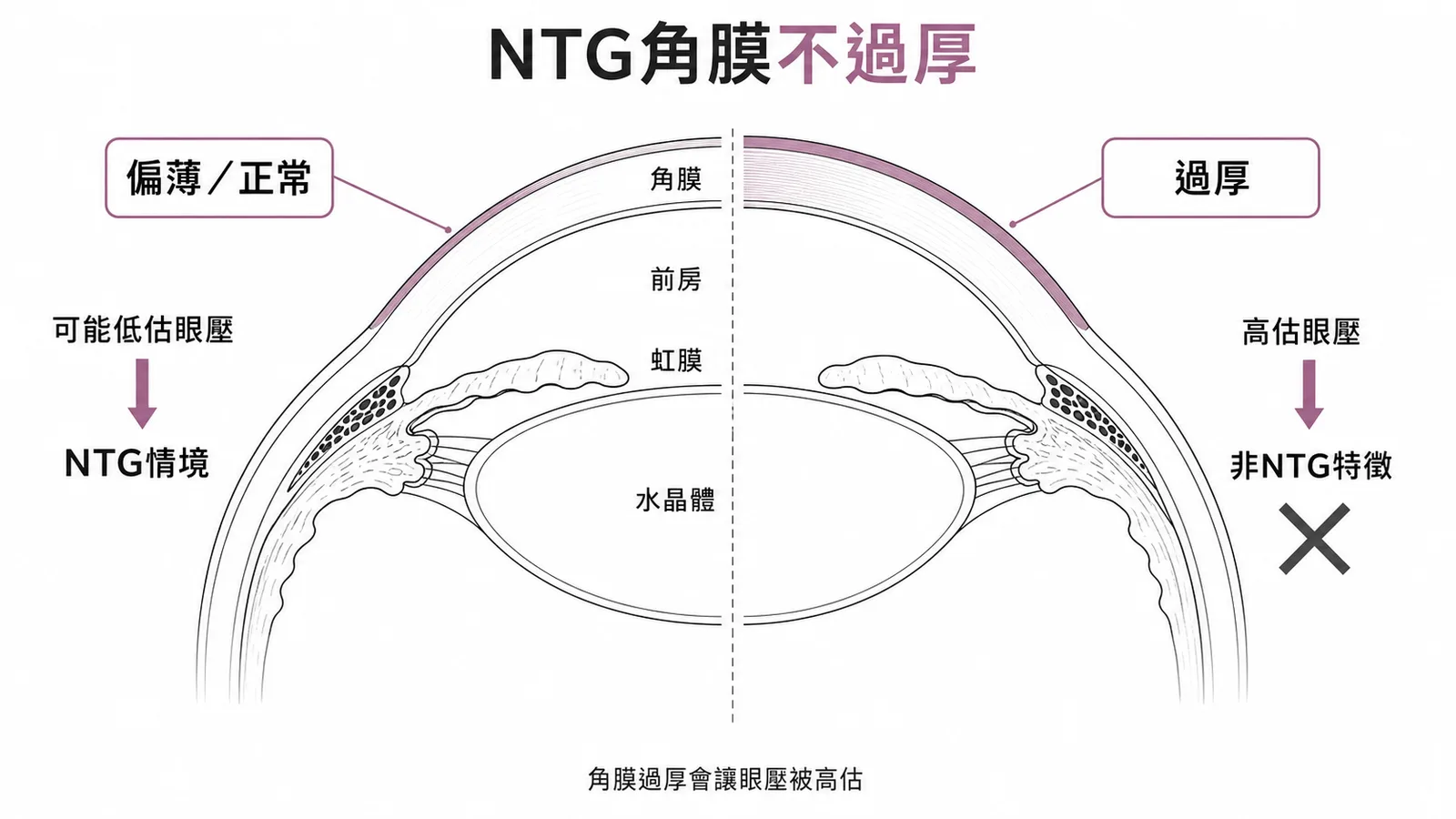正常眼壓性青光眼角膜厚度正常或偏薄而非過厚的示意圖