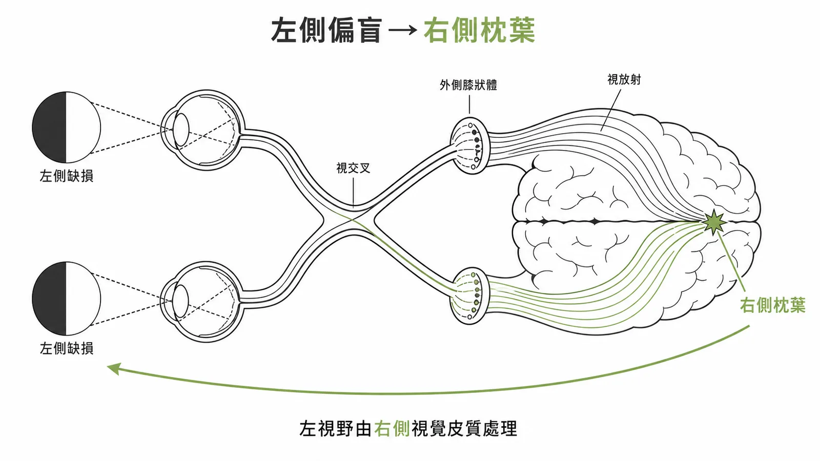 左側同側偏盲對應右側枕葉視覺皮質病變的視覺路徑示意圖