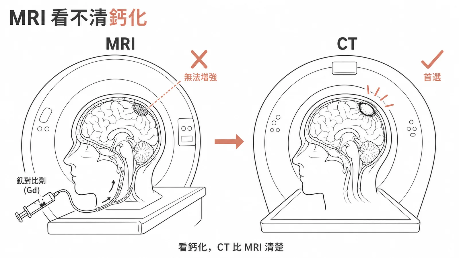 MRI顯影劑對鈣化無增強作用而CT能清楚顯示鈣化的對照圖